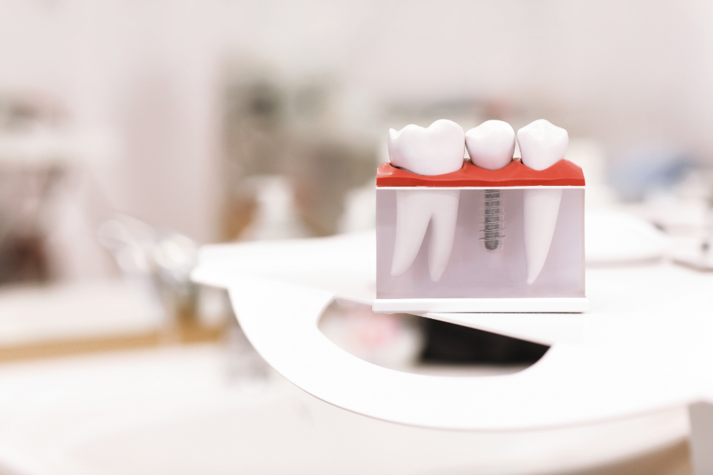 Dental Implants